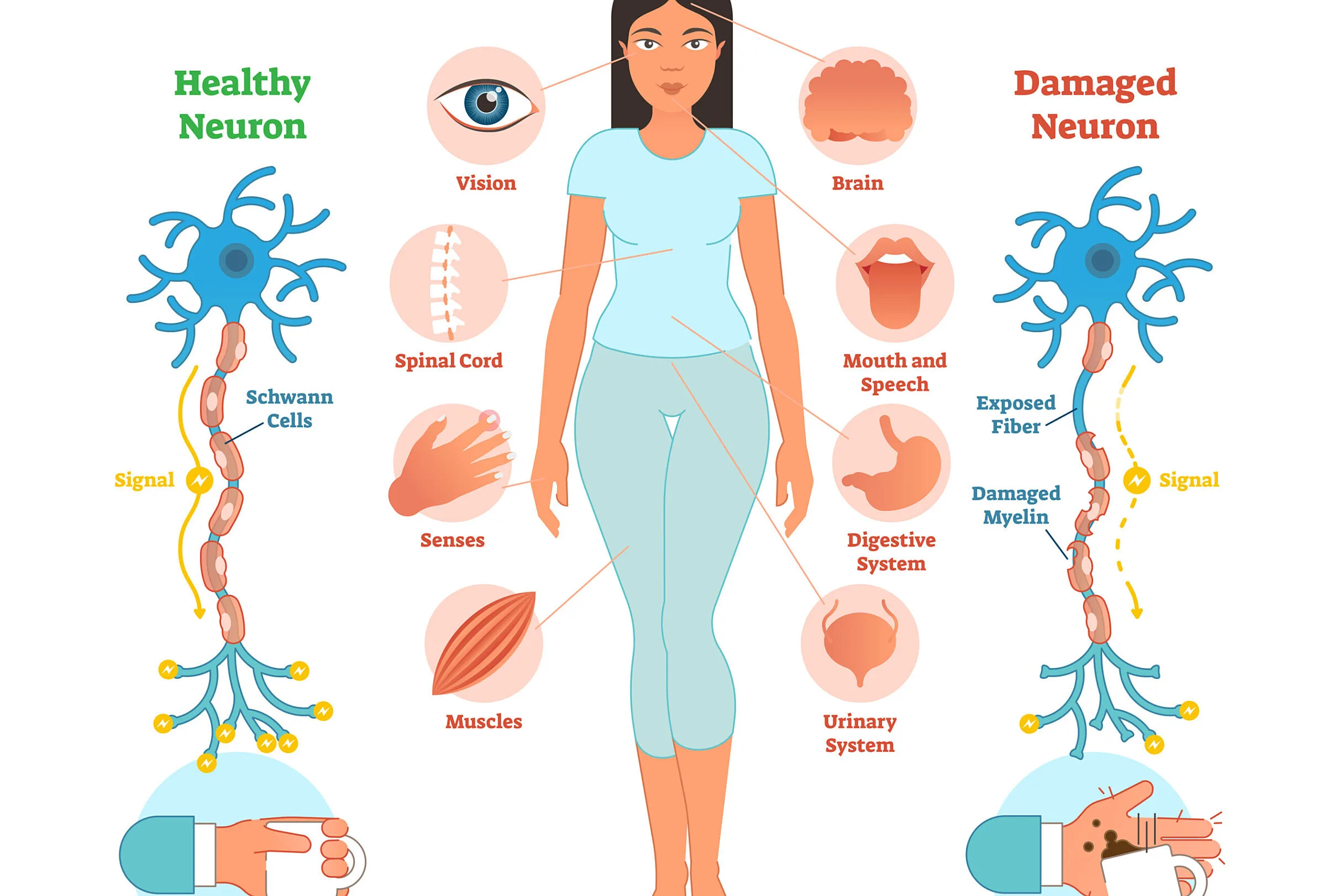 Множествената склероза и Юмейхо – надеждна алтернатива за подобряване на здравословното състояние